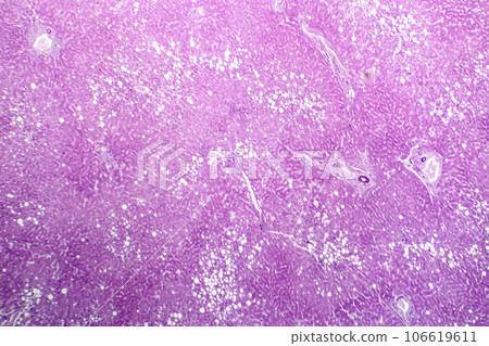 Hepatic steatosis, light micrograph 106619611