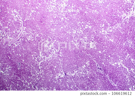 Hepatic steatosis, light micrograph 106619612