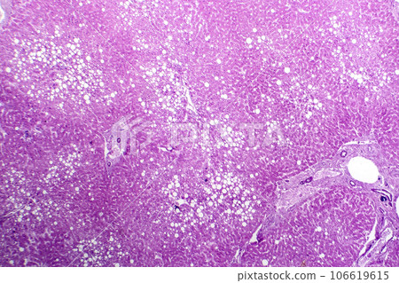 Hepatic steatosis, light micrograph Hepatic steatosis, light micrograph 106619615