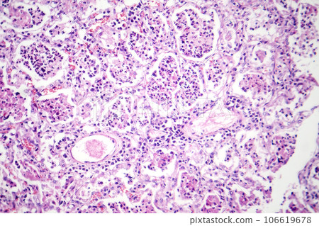 Lobar pneumonia in red hepatic phase, light micrograph Lobar pneumonia in red hepatic phase, light micrograph 106619678