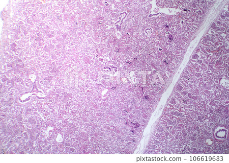 Lobar pneumonia in red hepatic phase, light micrograph 106619683