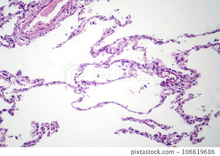 Diffuse emphysema, light micrograph Diffuse emphysema, light micrograph 106619686
