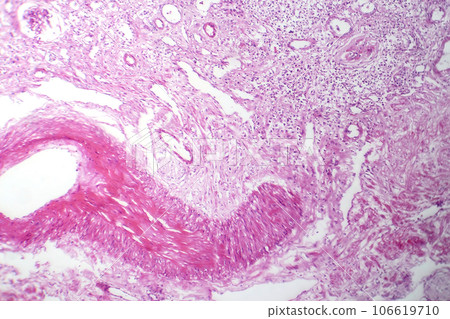 Primary particulate contracted kidney, light micrograph 106619710