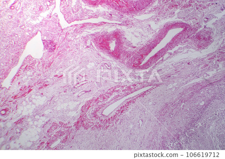Primary particulate contracted kidney, light micrograph 106619712