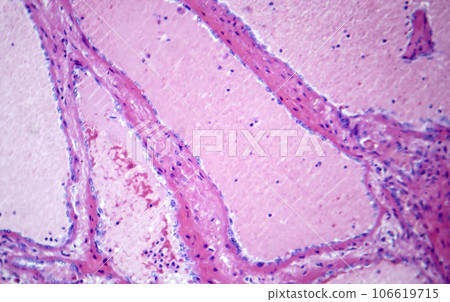 Hepatic cavernous hemangioma, light micrograph Hepatic cavernous hemangioma, light micrograph 106619715