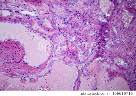 Hepatic cavernous hemangioma, light micrograph 106619716