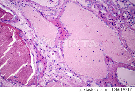 Hepatic cavernous hemangioma, light micrograph 106619717
