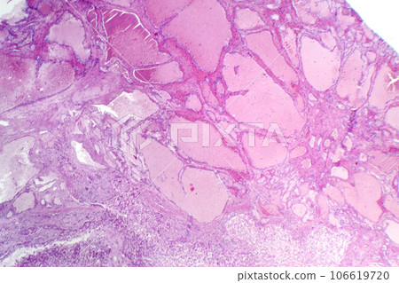 Hepatic cavernous hemangioma, light micrograph 106619720