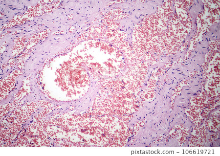 Capillary hemangioma, light micrograph Capillary hemangioma, light micrograph 106619721