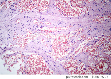 Capillary hemangioma, light micrograph Capillary hemangioma, light micrograph 106619724