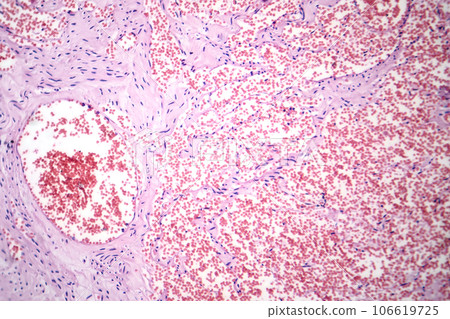 Capillary hemangioma, light micrograph Capillary hemangioma, light micrograph 106619725
