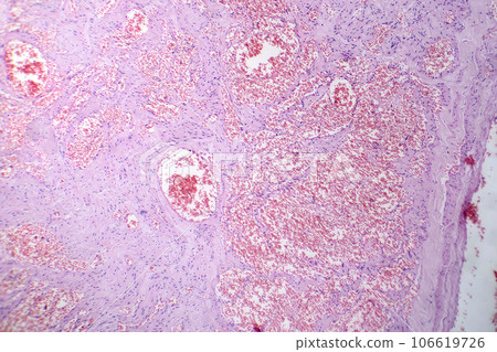 Capillary hemangioma, light micrograph 106619726