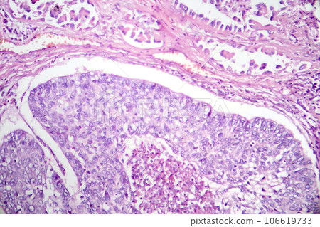 Lung adenocarcinoma, light micrograph Lung adenocarcinoma, light micrograph 106619733