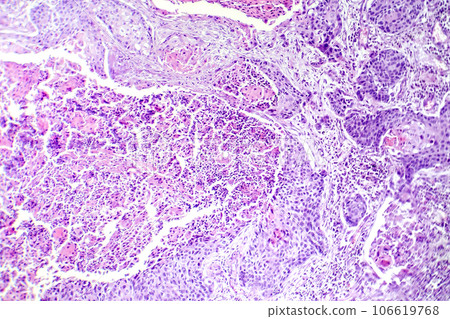 Squamous cell carcinoma of the lung, light micrograph Squamous cell carcinoma of the lung, light micrograph 106619768