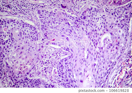 Squamous cell carcinoma of the lung, light micrograph Squamous cell carcinoma of the lung, light micrograph 106619828