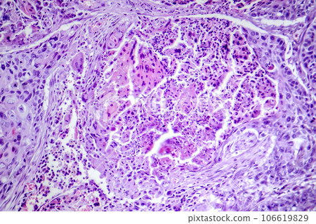 Squamous cell carcinoma of the lung, light micrograph 106619829