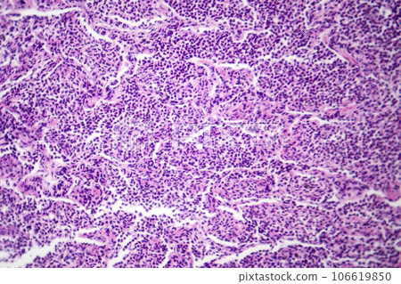 Interstitial pneumonia, light micrograph 106619850