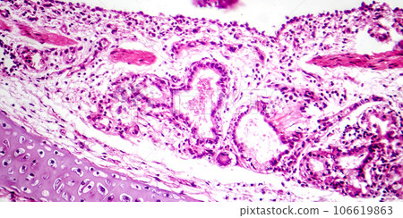 Photomicrograph of bronchopneumonia, lobular pneumonia Photomicrograph of bronchopneumonia, lobular pneumonia 106619863