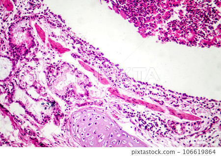 Photomicrograph of bronchopneumonia, lobular pneumonia 106619864