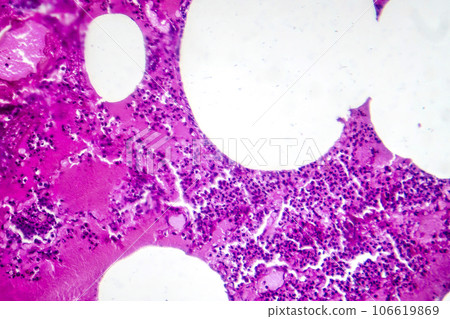 Lobar pneumonia during the hemorrhagic edema period, light micrograph 106619869