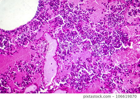 Lobar pneumonia during the hemorrhagic edema period, light micrograph Lobar pneumonia during the hemorrhagic edema period, light micrograph 106619870