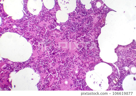 Lobar pneumonia during the hemorrhagic edema period, light micrograph Lobar pneumonia during the hemorrhagic edema period, light micrograph 106619877