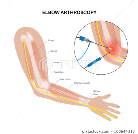 Elbow arthroscopy surgery Elbow arthroscopy surgery 106644316