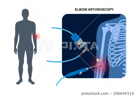 Elbow arthroscopy surgery Elbow arthroscopy surgery 106644318