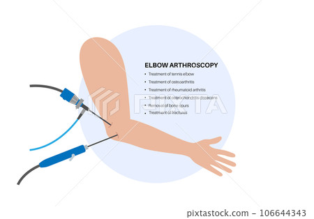 Elbow arthroscopy surgery 106644343