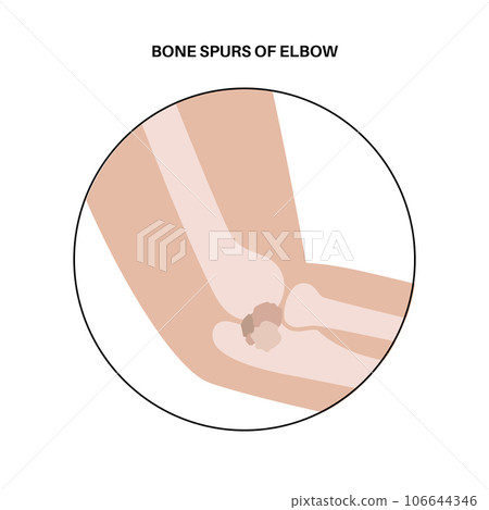 Bone spurs of elbow Bone spurs of elbow 106644346