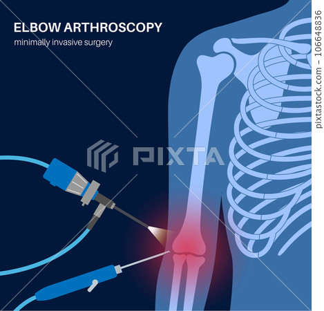 Elbow arthroscopy surgery Elbow arthroscopy surgery 106648836
