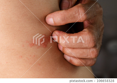 Man with shingles disease, skin infected with Herpes zoster, virus, Healthcare and medical. Man with shingles disease, skin infected with Herpes zoster, virus, Healthcare and medical. 106658328