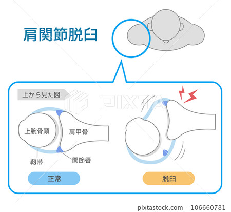 從上方觀察肩關節脫位的機制和原因 106660781