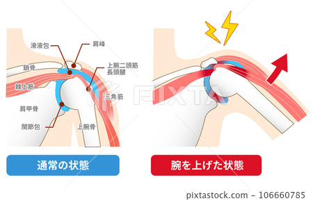 Impingement syndrome. Causes and mechanisms of pain when raising the arm Impingement syndrome. Causes and mechanisms of pain when raising the arm 106660785