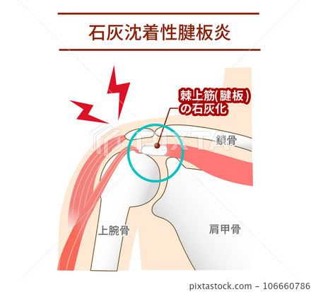 Causes and mechanism of calcific tendonitis 106660786