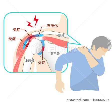 Shoulder periarthritis, man suffering from frozen shoulder pain 106660793