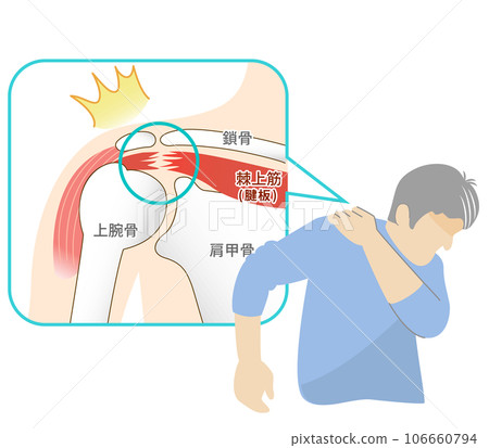 一名因肩袖撕裂而感到疼痛的男子 106660794