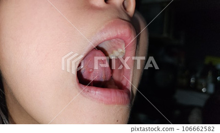 兒童小唾液腺瀦留囊腫 兒童小唾液腺瀦留囊腫 106662582