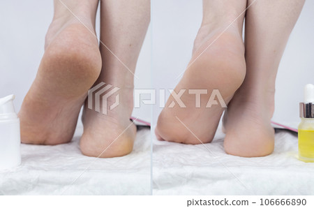 Cracked heels. Woman feet before and after procedures to soften rough skin. Urea cream, oil for care of keratinized skin, healing of cracked foot. Usage foot grater, cream with urea, softening oil. 106666890