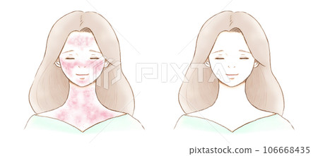 患有導致發紅的皮膚病的女性和完全康復的女性 106668435