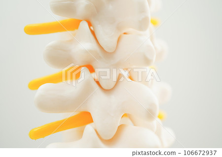 Spinal nerve and bone, Lumbar spine displaced herniated disc fragment, Model for treatment medical in the orthopedic department. 106672937