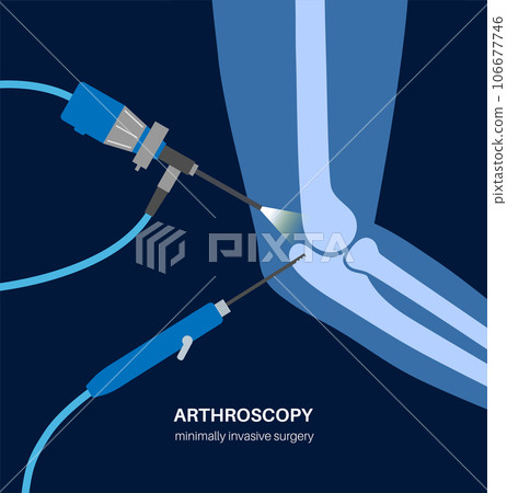 Elbow arthroscopy surgery 106677746