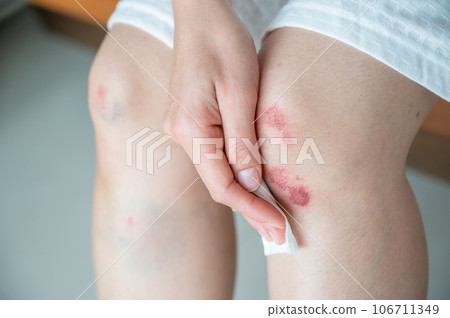 Cropped shot of woman using tissue paper to clean her wound after Injured occur from falling or impact floor. Bruises happen when small blood vessels in the skin are damaged. 106711349