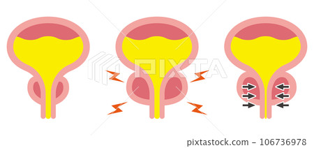Illustration of normal prostate and prostatic hypertrophy Illustration of normal prostate and prostatic hypertrophy 106736978
