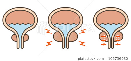 Illustration of normal prostate and prostatic hypertrophy Illustration of normal prostate and prostatic hypertrophy 106736980