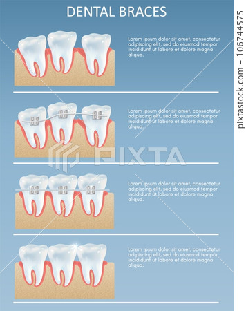 Dental braces infographic brochure orthodontic dentistry poster Dental braces infographic brochure orthodontic dentistry poster 106744575