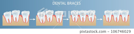 Dental teeth braces installation steps vector poster Dental teeth braces installation steps vector poster 106746029