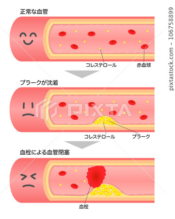 Illustration of a cross-sectional diagram of a blood vessel with a face showing progressing arteriosclerosis 106758899