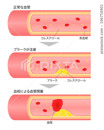 進展性動脈硬化橫截面圖的比較說明圖 106758901