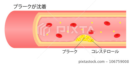 動脈粥樣硬化導致斑塊變窄的血管橫截面圖插圖 動脈粥樣硬化導致斑塊變窄的血管橫截面圖插圖 106759008